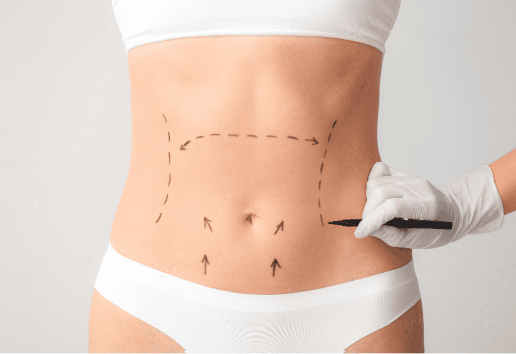 Abdominoplastia Dr. David Mognato