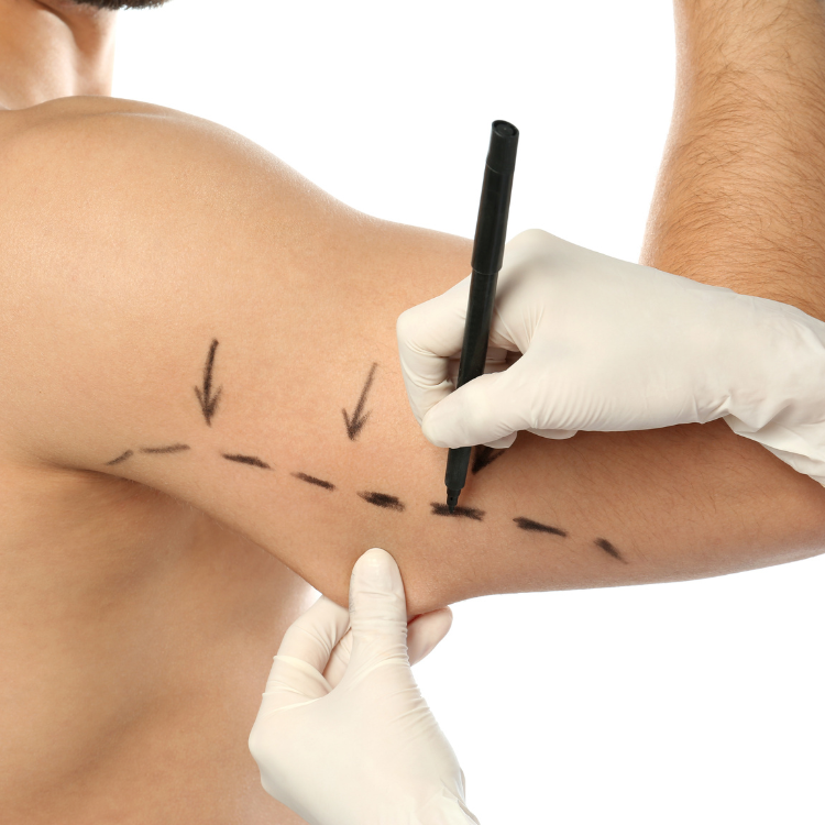 Braquioplastia Dr. David Mognato: Transformação para Braços Mais Firmes