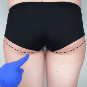 Gluteoplastia: Como Conquistar Resultados Harmoniosos e Naturais