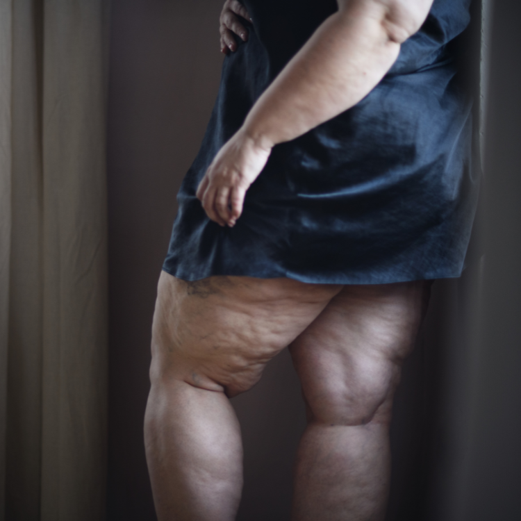 Lipedema: Resultados Comprovados para Alívio dos Sintomas